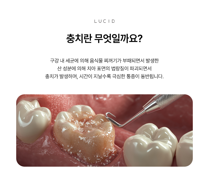 Yeoksam Station Dental Clinic: Once Cavity Treatment Is Done, Management Begins image 3