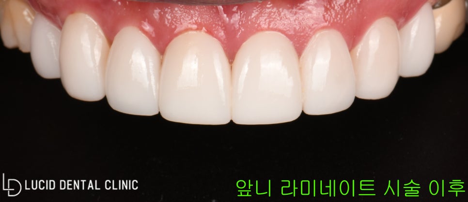 선정릉역 치과 추천 - 위턱 앞니 치아 마모증 라미네이트 시술 로 개선한 이야기 관련 이미지 2