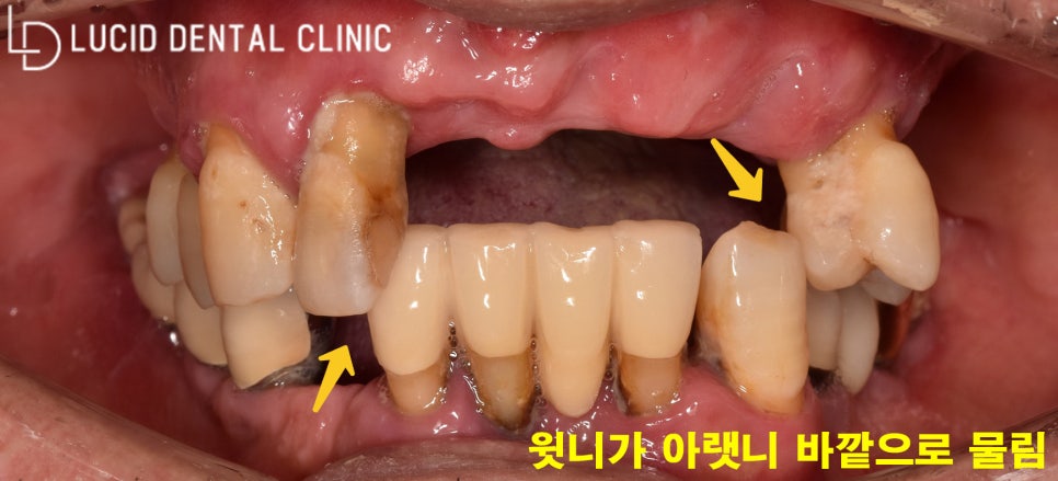 선정릉역 임플란트 로 교합되지 않던 치아를 개선해 드린 이야기 관련 이미지 2