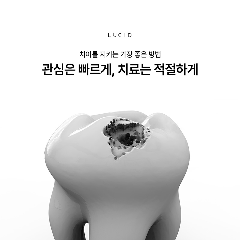 Why Cavities Should Be Treated Promptly | Gangnam Station Dental Clinic image 1