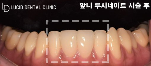 벌어진 앞니 사이 고민, 선정릉역 치과 에서 라미네이트 받고 날려버리세요! 관련 이미지 4
