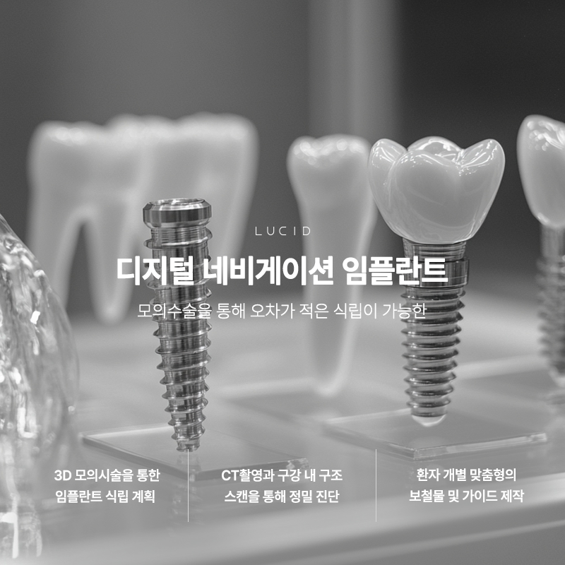 강남치과 네비게이션임플란트 믿고 받는 수술 가이드 관련 이미지 1