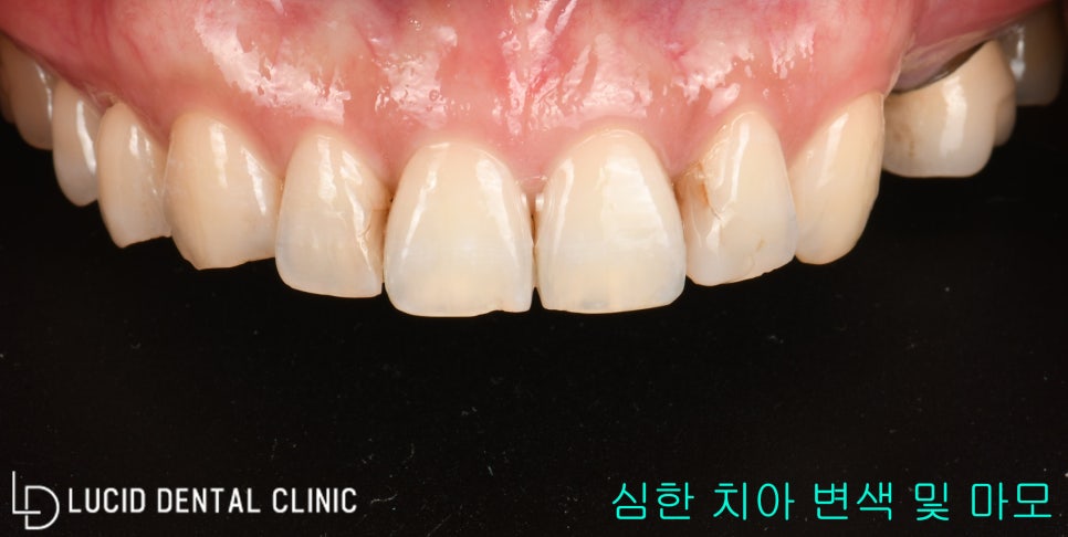 치아 사이 인접면 변색 & 마모, 신논현역 치과 라미네이트 시술로 빠르게 해결해 보세요! 관련 이미지 1