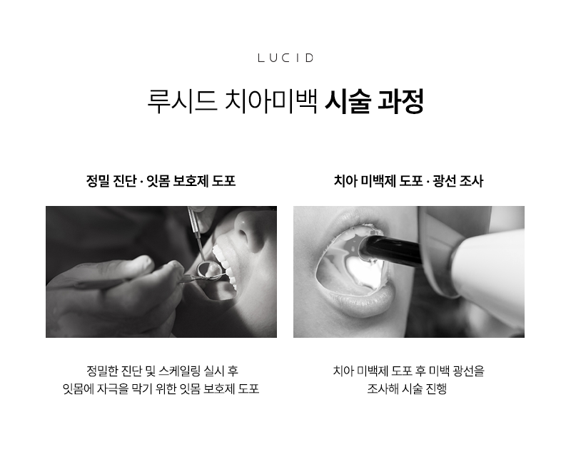 If You Have a Wedding or Interview Coming Up? Teeth Whitening at Nonhyeon Dental Clinic image 5