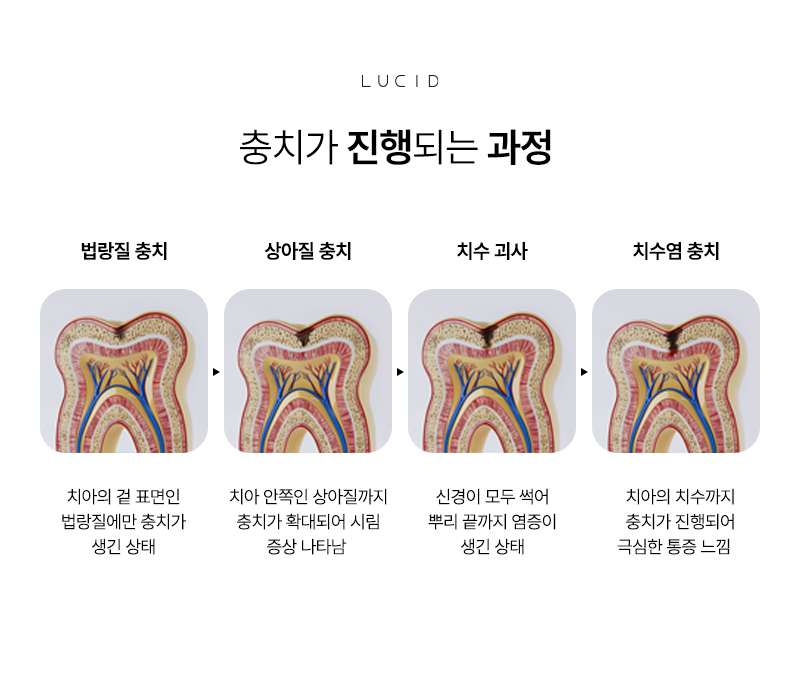 Yeoksam Station Dental Clinic: Once Cavity Treatment Is Done, Management Begins image 4