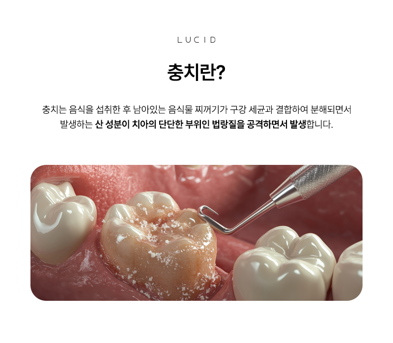 역삼동치과 어린이 충치, 방치하지 마세요 관련 이미지 3