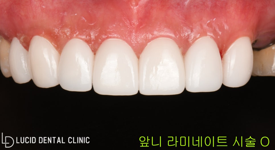 역삼동 치과 - 앞니 치아 마모 및 변색, 원데이 라미네이트 시술로 빠르고 간편하게! 관련 이미지 2
