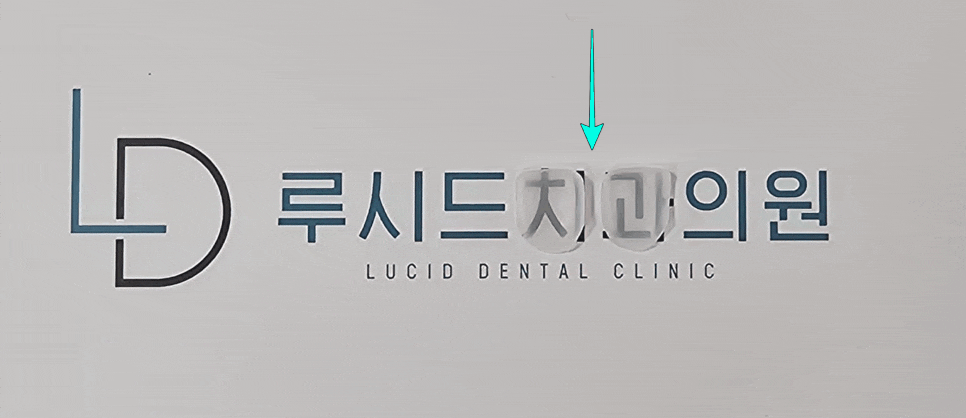 깃털처럼 가벼운 라미네이트 시술, 가능할까요? 신논현역 치과 의 숨은 꿀팁 대방출 관련 이미지 3
