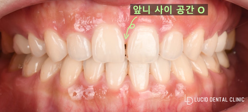 누렇게 변색하고 삐뚤어진 앞니 치아, 하루 만에 바뀔 수 있습니다! - 서초동 치과 원데이 라미네이트 시술 후기 관련 이미지 1