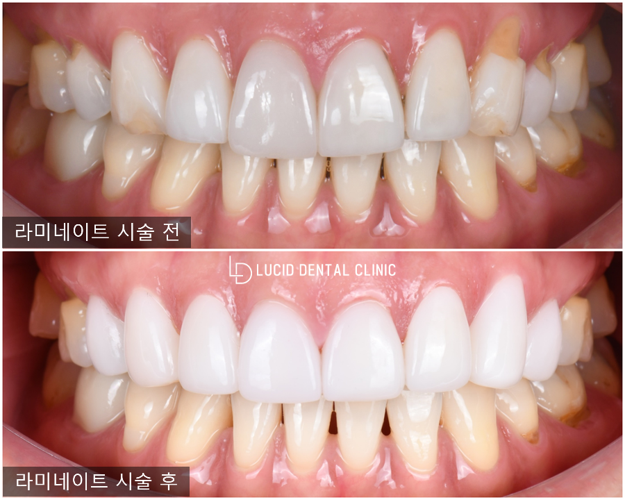 타원에서 받은 라미네이트 깨짐 및 떨어짐, 단 하루 만에 개선한 선정릉역 치과 시술 후기 및 전후 비교 (feat. 잇몸 성형 동반) 관련 이미지 3