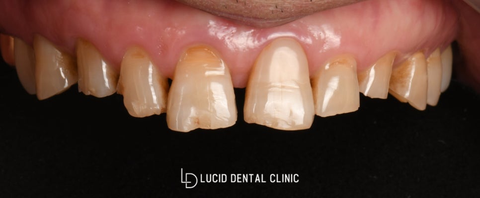 치주염으로 비어보이는 치아, 강남역 치과 에서 루시네이트 시술 후기 관련 이미지 2