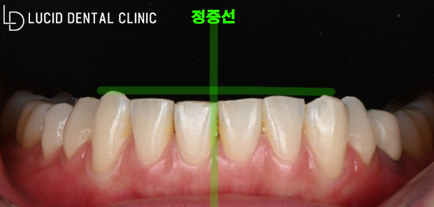 비대칭이고 삐뚤어진 치아 고민, 언주역 치과 라미네이트 로 해결해 드릴 수 있습니다. 관련 이미지 3