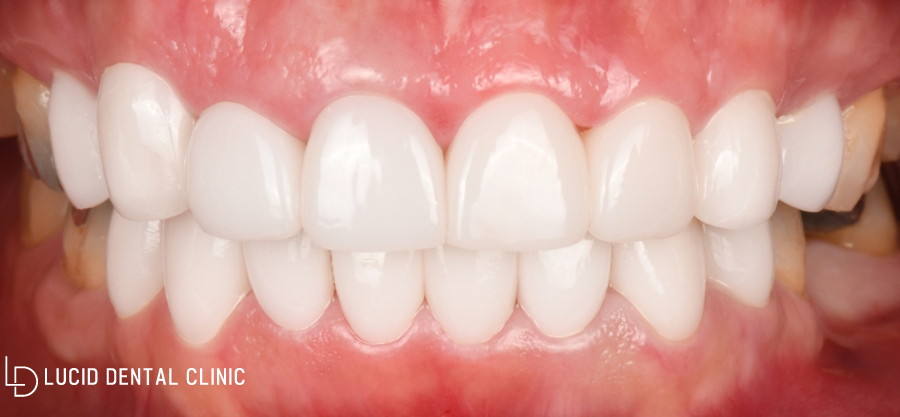 연예인 치아처럼 바뀌는 논현동 치과 최소삭제 라미네이트 시술 후기 관련 이미지 3