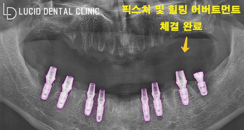 역삼역 임플란트 - 흔들리는 치아, 그냥 둘 건가요? 관련 이미지 3