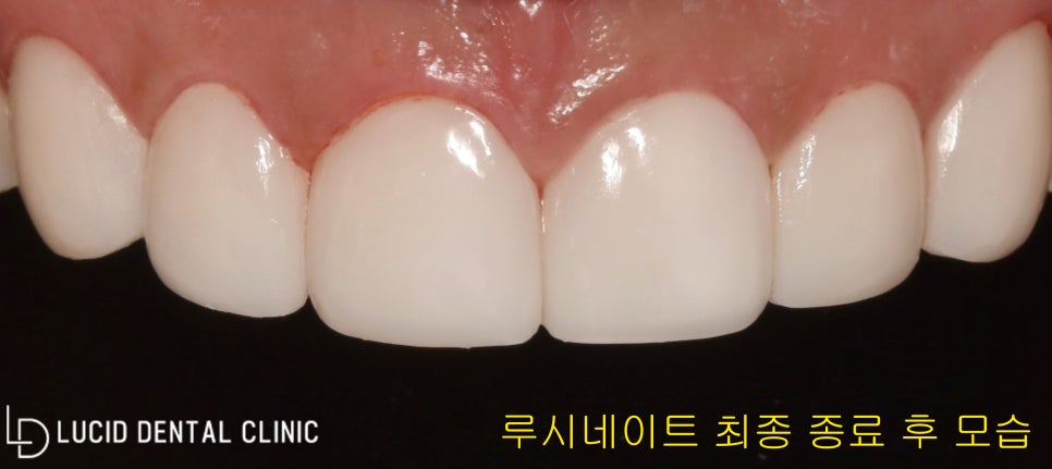 역삼동 치과 앞니 치아 벌어짐, 한 번에 개선할 수 있는 루시네이트 시술 후기 관련 이미지 2