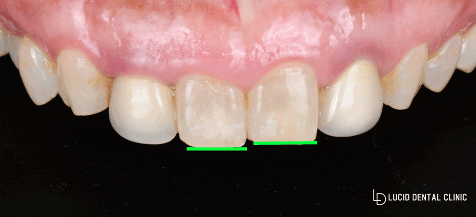 신논현역 치과 "삐뚤빼뚤하고 높이가 안 맞는 치아" 하루 만에 라미네이트(Laminate Veneer) 수복 관련 이미지 1