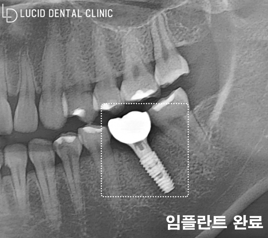 어금니 통증 알고 보니 염증 질환? 신논현역 치과 디지털 임플란트 로 되찾은 치아 기능 관련 이미지 6