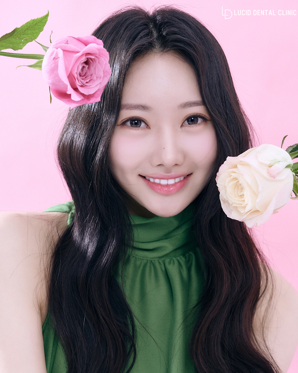 논현역 치과 치아교정없이 틀어진 앞니 토끼이빨 배열 개선 가능한 루시네이트 시술 후기 관련 이미지 6