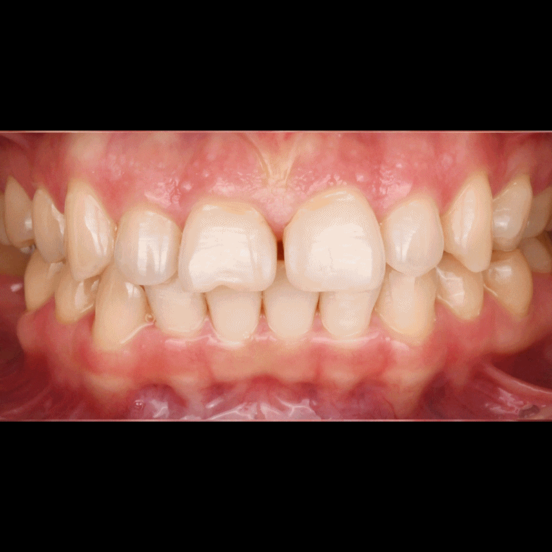 Improvement Case for Gapped Front Teeth with Lusinate Instead of Orthodontics image 3