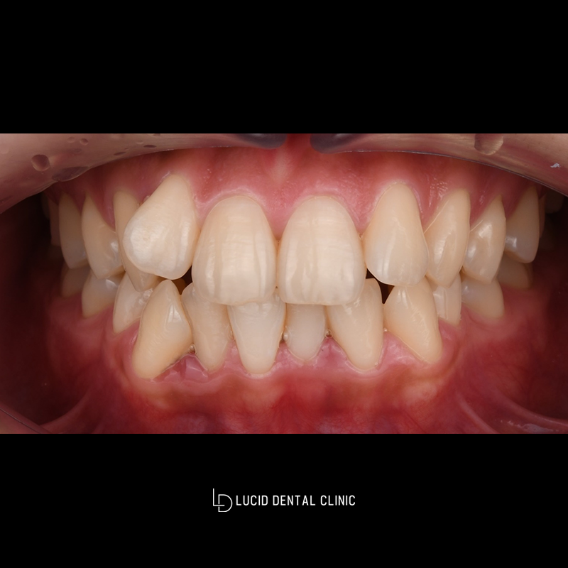 Improving Crooked Front Teeth and Uneven Tooth Alignment with Lucinate image 1