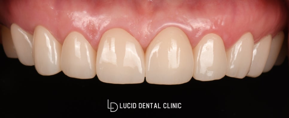 치주염으로 비어보이는 치아, 강남역 치과 에서 루시네이트 시술 후기 관련 이미지 3