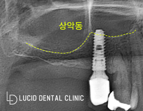 자연치가 없다면? 논현동 치과 에서 임플란트 이용한 대처 방법, 기능, 편리성 알려드립니다. 관련 이미지 4