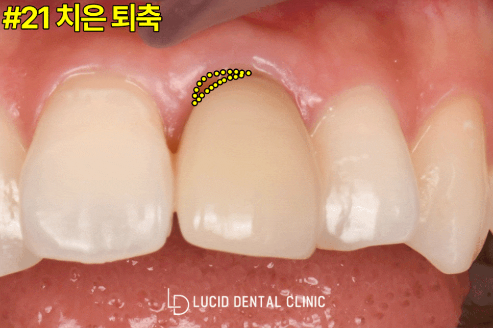 논현동 치과 에서 교정 없이, 라미네이트 시술 로 뻐드렁니 개선해 드린 사례 관련 이미지 3