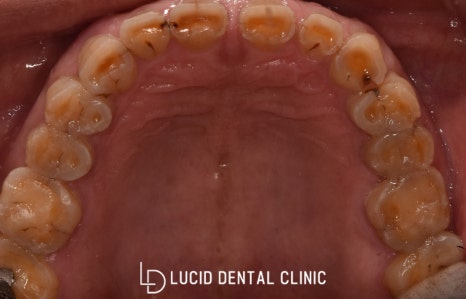 치아 소실과 무너진 교합 고경(Vertical Demension), 전악 보철 크라운 치료 로 개선해 드린 학동역 치과 추천 full mouth rehabilitation 관련 이미지 4