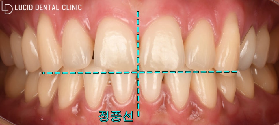 서초동 치과 라미네이트 시술 잘하는곳은 이걸 사용하고 있습니다. 관련 이미지 1
