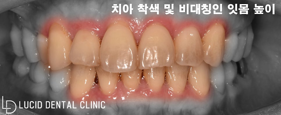 까맣게 변색된 치아, 강남역 치과 에서 라미네이트 로 해결 가능합니다! 관련 이미지 1