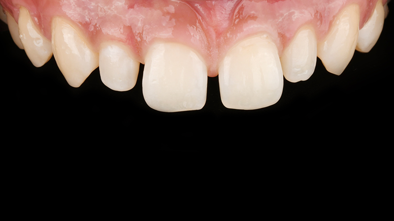 Hakdong Dental Clinic: Closing Gaps Between Front Teeth with Lucinate image 2