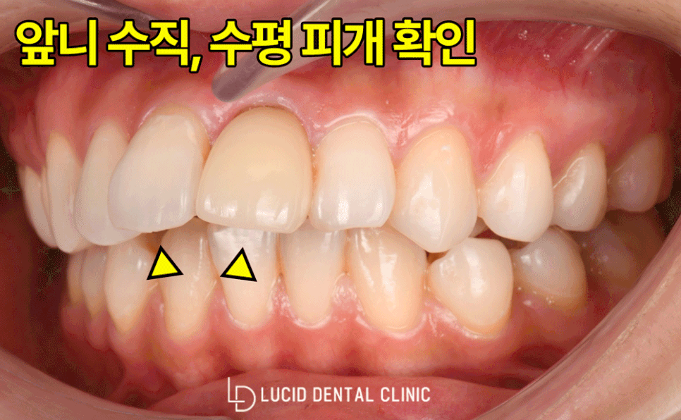 논현동 치과 에서 교정 없이, 라미네이트 시술 로 뻐드렁니 개선해 드린 사례 관련 이미지 4