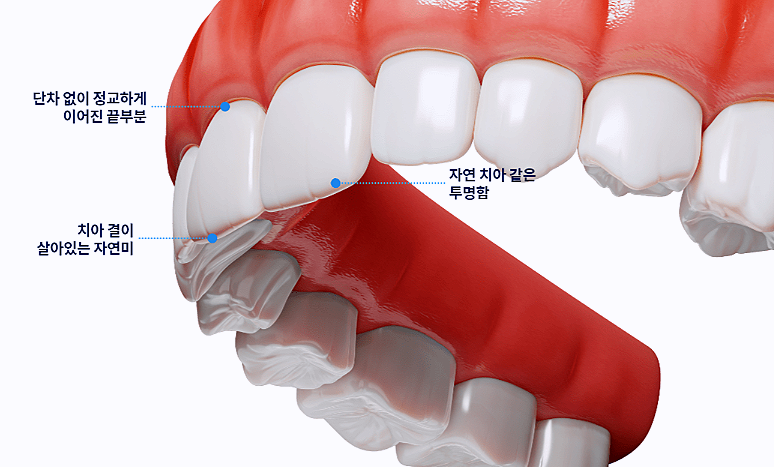 라미네이트 빠짐 의 원인 및 부작용, 대처 방법까지 역삼역 치과 가 알려드리겠습니다. 관련 이미지 1