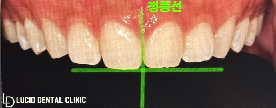 내 치아에 하얀 반점이? 교정 후 생긴 화이트 스팟 치아 탈회, 학동역 치과 에서 라미네이트 로 해결해 드렸습니다. 관련 이미지 2
