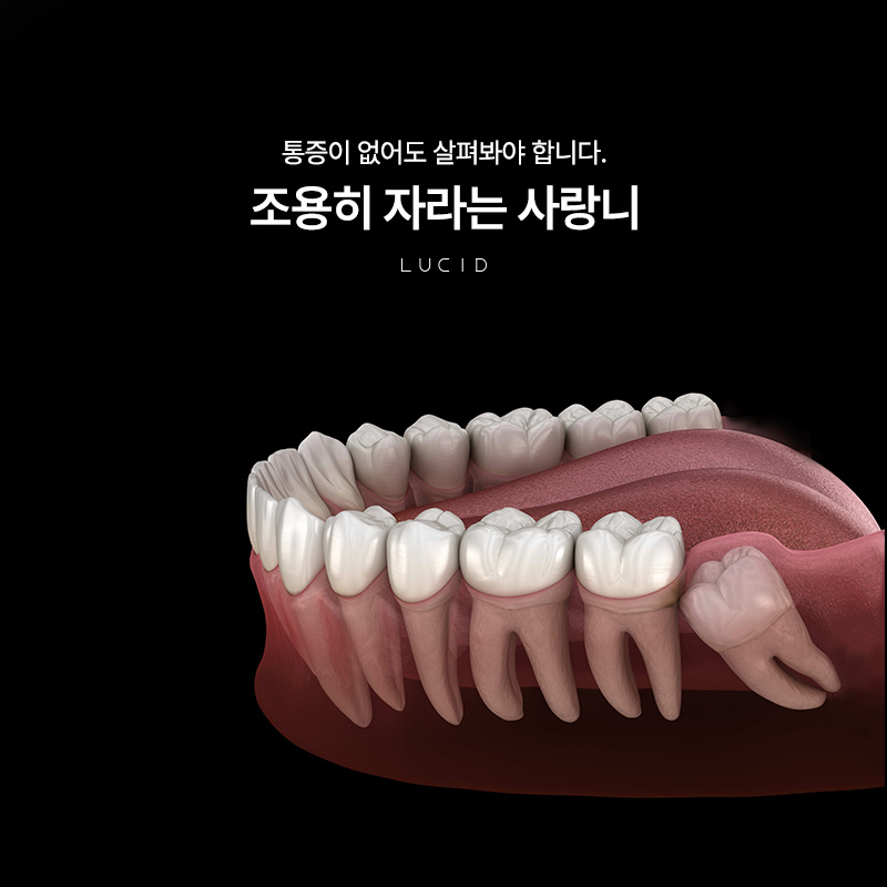 Gangnam Impacted Wisdom Tooth Extraction: Problems That Can Occur If Left Untreated image 1