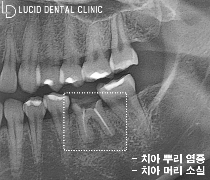 어금니 통증 알고 보니 염증 질환? 신논현역 치과 디지털 임플란트 로 되찾은 치아 기능 관련 이미지 4