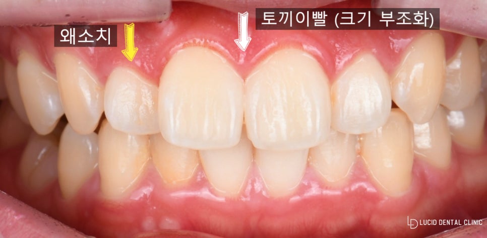 서초동 치과 라미네이트 치료 받기 전에 알아야 될 주의 사항 (feat. 토끼이빨 앞니 크기 부조화 개선) 관련 이미지 1