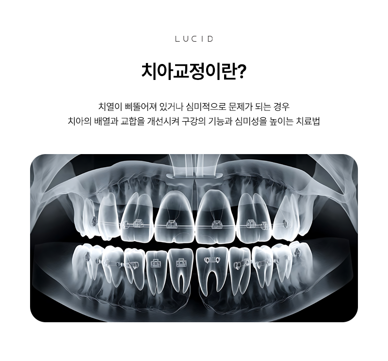 Is Orthodontic Treatment Really Necessary at an Yeoksam-dong Dental Clinic? image 3