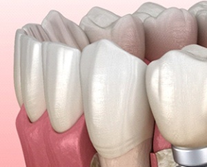 역삼동 치과 임플란트 수술 후 부작용 및 통증 원인, 해결 방법은? 관련 이미지 1