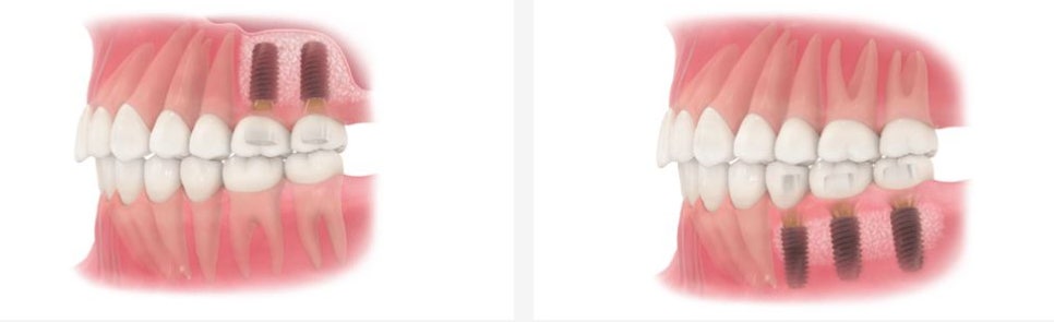 역삼역 치과 루시드 에서 알려드리는 임플란트와 브릿지, 틀니 관련 이미지 4