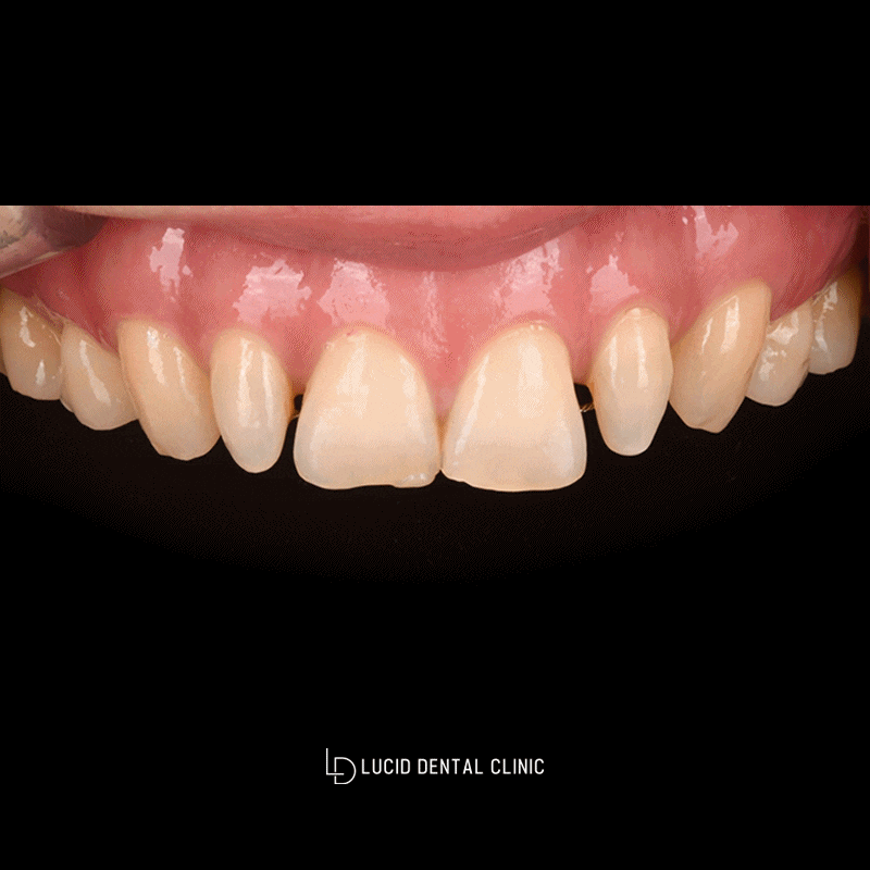 Improving the Gap Between the Front Teeth with Lucinate image 3