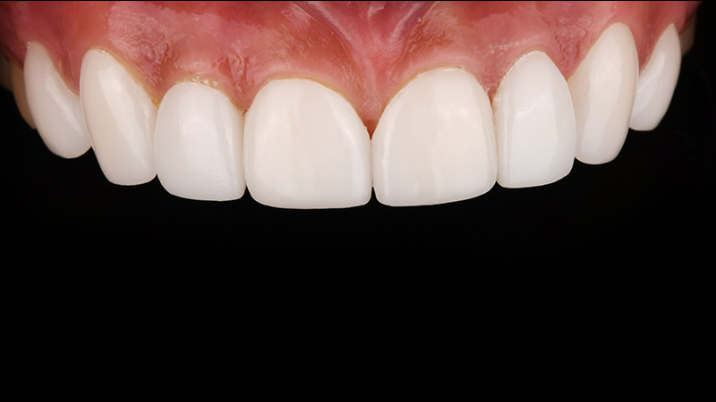 Hakdong Dental Clinic: Closing Gaps Between Front Teeth with Lucinate image 3