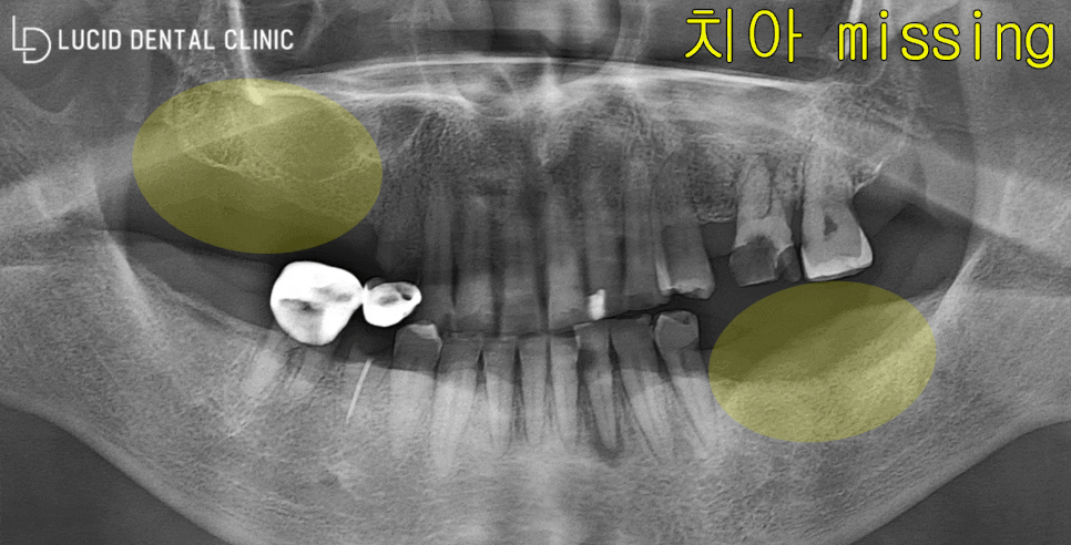 다수의 치아 상실, 임플란트 잘하는 논현동 치과 치료로 구강 건강 되찾아드렸습니다. 관련 이미지 2