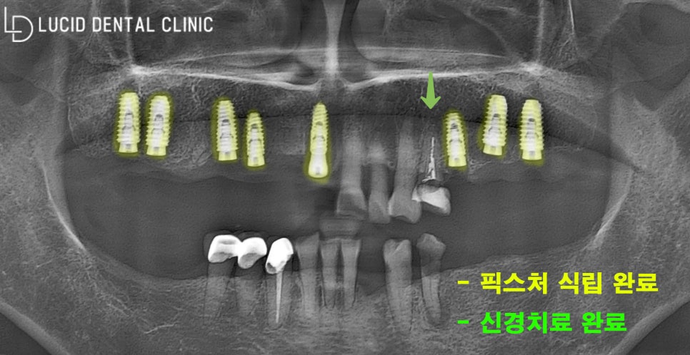 논현역 임플란트 가이드로 더욱 안전하고 편하게 식립해드렸습니다! 관련 이미지 3