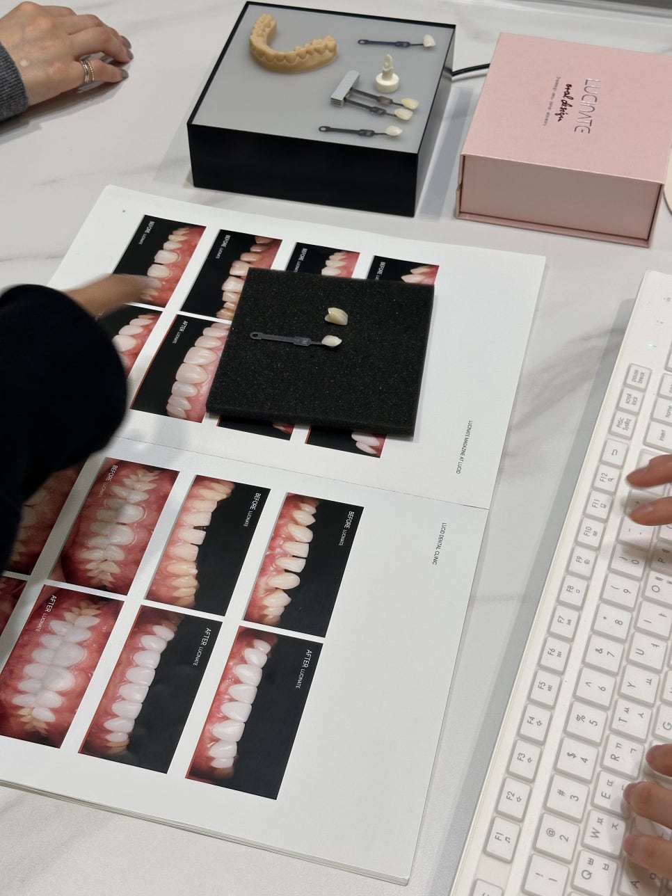 역삼동치과 치아 라미네이트ㅣ시림부터 색 불만까지 재시술 원인과 접근법 관련 이미지 3