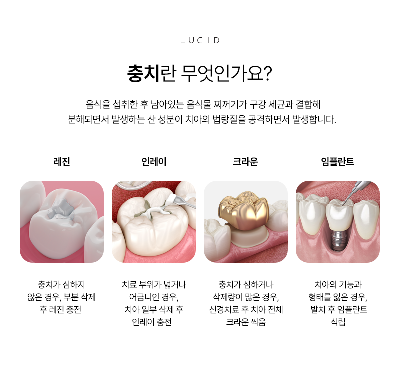 Nonhyeon-dong Cavity Treatment Starts with a Clear Understanding image 3