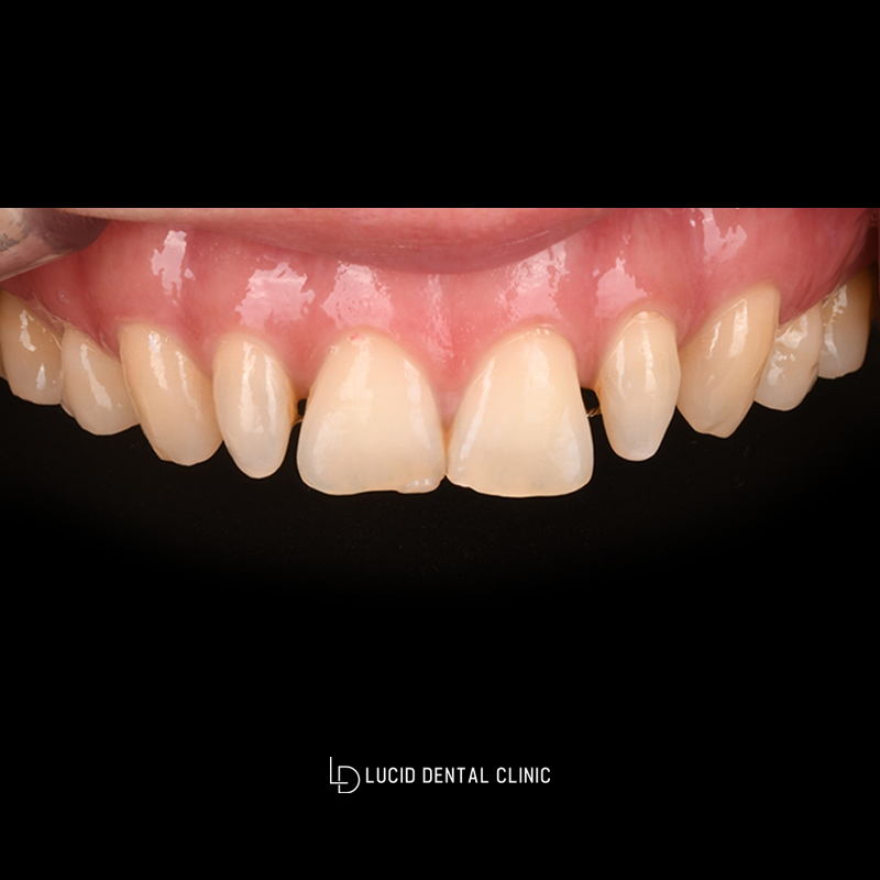 Improving the Gap Between the Front Teeth with Lucinate image 1