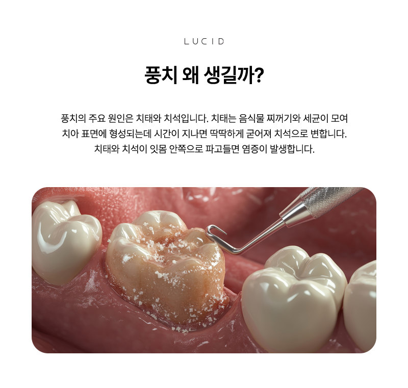 언주역치과 풍치 예방의 핵심 스케일링과 올바른 칫솔질 관련 이미지 3