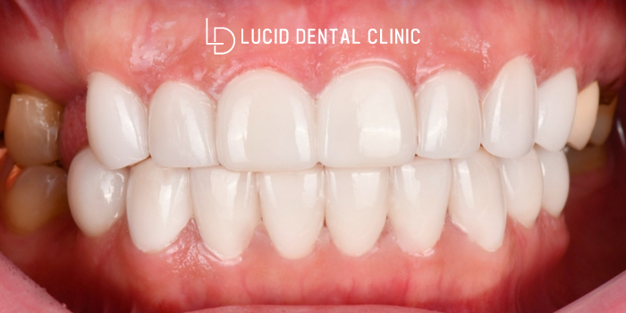 서초동 치과 "벌어진 앞니 사이에 생긴 까만 점, 정체는?" 라미네이트 치료 후기 (feat. 치간 이개 Diastema) 관련 이미지 2