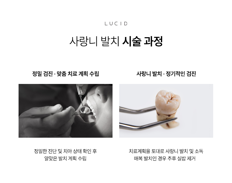 강남역 근처 치과 사랑니발치 후 운동 가능한 시점 관련 이미지 5